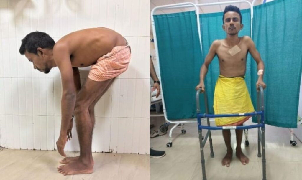 ଏମ୍ସ ଭୁବନେଶ୍ୱର ବିରଳ ଅସ୍ତ୍ରୋପଚାର, ବଙ୍କା ହୋଇପଡିଥିବା ମଣିଷ ସିଧା ହେଲା ଏମ୍ସ ଭୁବନେଶ୍ୱର