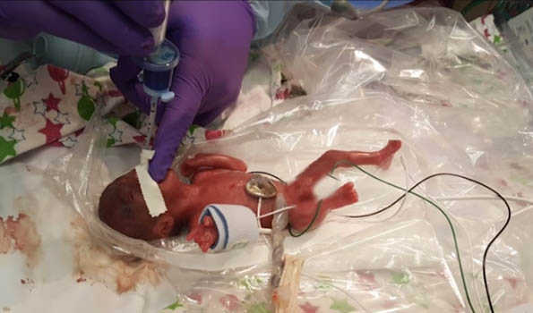 World's tiniest surviving baby born in California