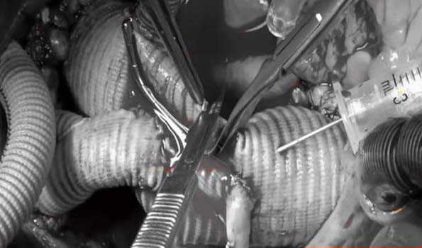 Frozen Elephant Trunk procedure best for treating dissecting aortic aneurysm