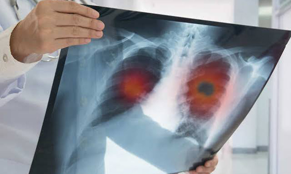 AI to determine if immunotherapy is working in lung cancer