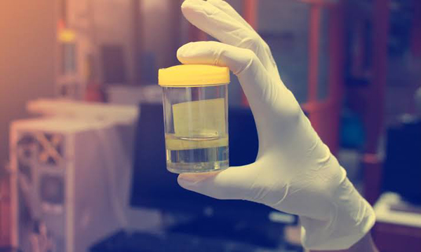 Home urine test kit can accurately spot prostate cancer risk