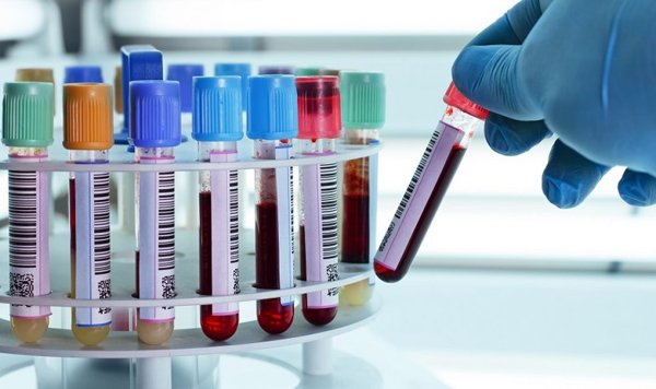 This blood test may predict onset of tuberculosis